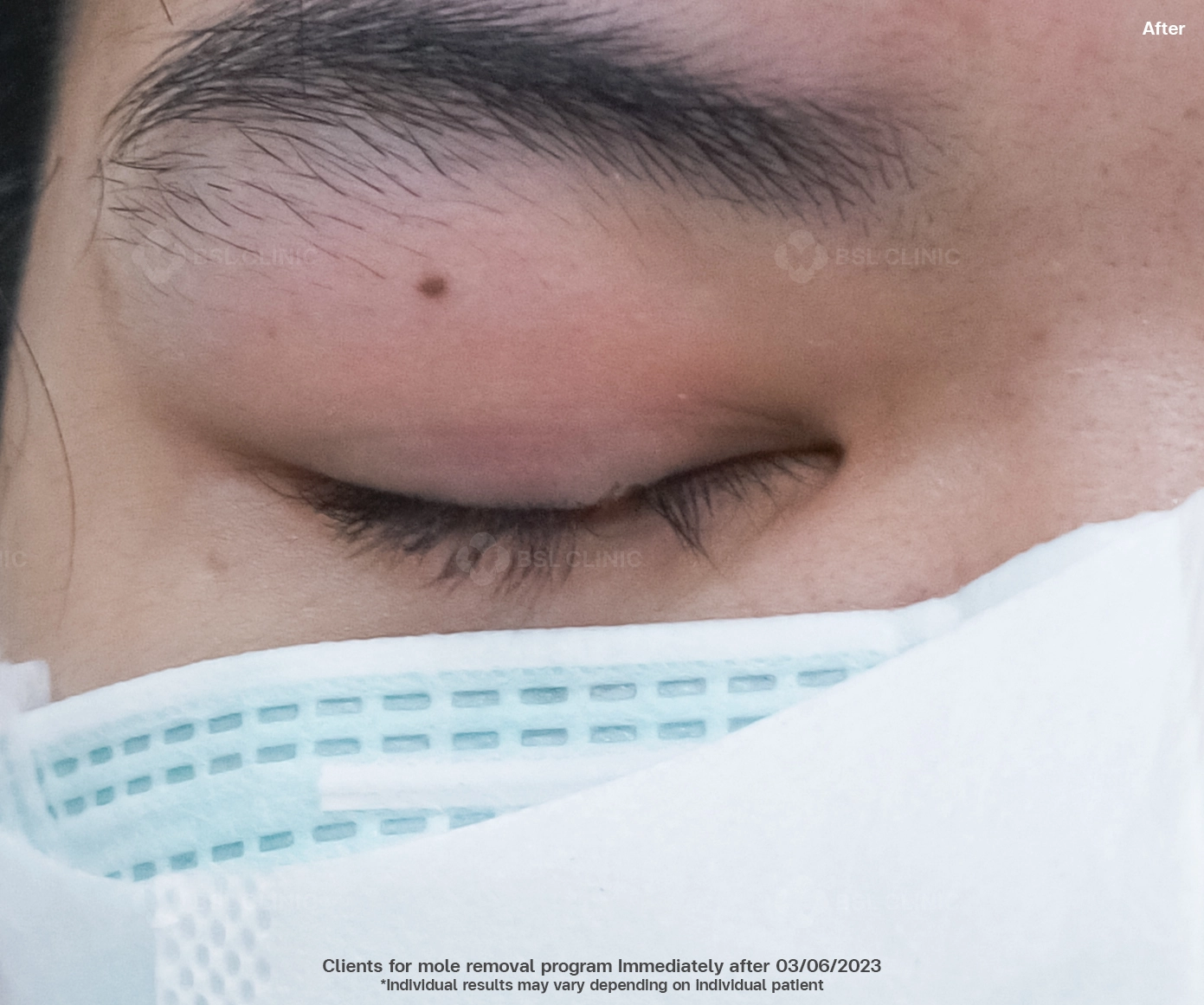 after-co2-laser-bangkok-mole-removal-near-eyelid-at-bsl-clinic-thailand-gentle-skin-tag-removal-bangkok-price-safe-treatment-for-milia-syringoma-co2-laser-thailand-clear-skin-results-bangkok-mole-removal