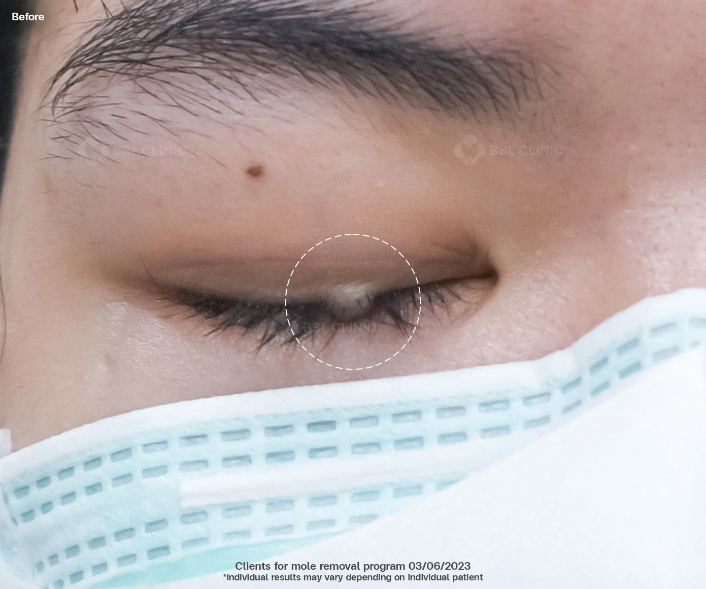 before-and-after-mole-removal-near-eyes-using-co2-laser-bangkok-skin-tag-removal-at-bsl-clinic-thailand-safe-and-precise-treatment-for-milia-syringoma-and-skin-tags-co2-laser-bangkok-price-skin-tag-removal-thailand-bangkok-mole-removal