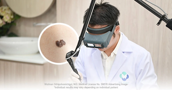 Effective Solutions for Skin Tags, Milia, and Facial Bumps