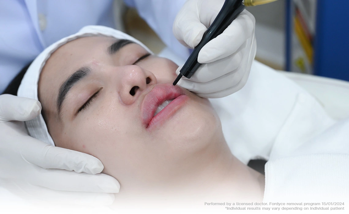 micro pulse co2 laser treatment upper lip fordyce spot removal skin tag milia smooth healing bsl clinic