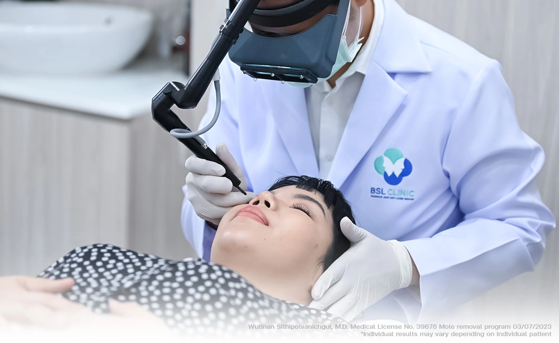 mole removal with co2 laser near eyelid skin tag and facial lesion treatment bsl clinic