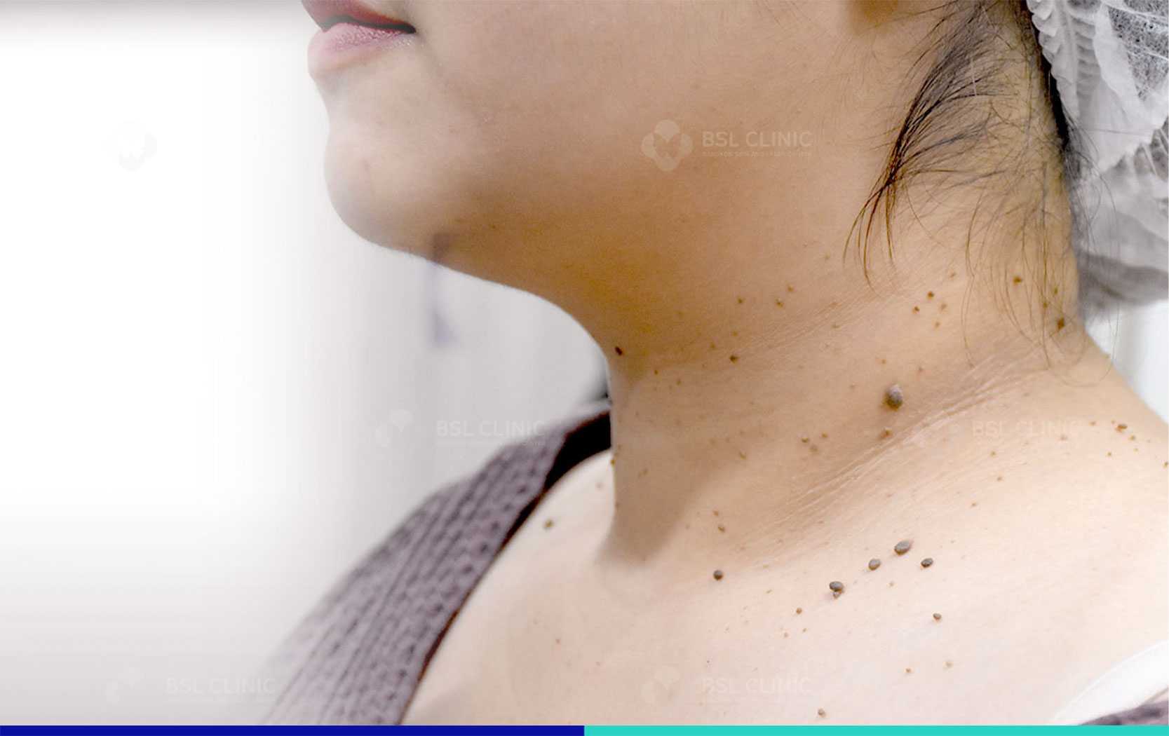 skin-tags-around-neck-and-shoulder-areas