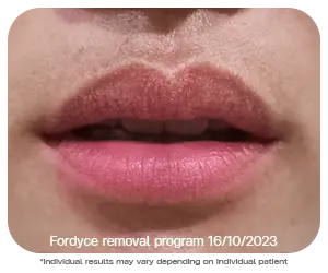 fordyce spot on upper lip close up cosmetic laser concern bsl clinic milia skin tag treatment