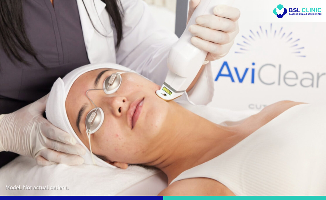 AviClear-Laser-treatment