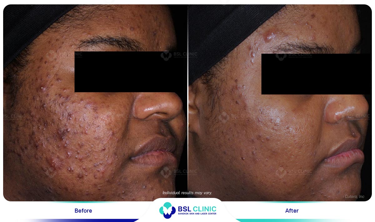 Result-AviClear-Before-After-01