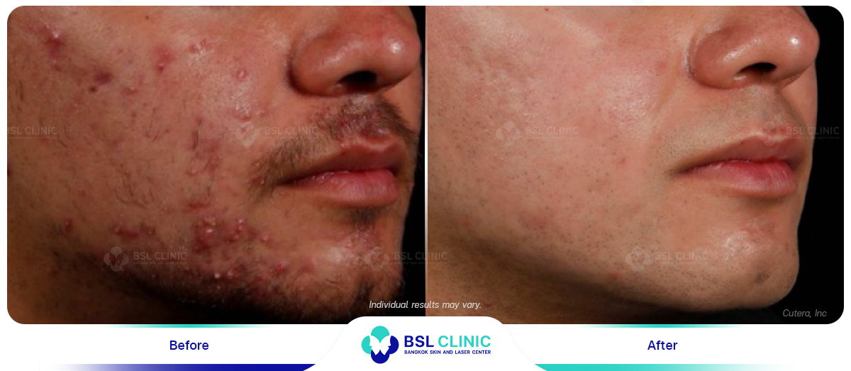 Result-AviClear-Before-After-03