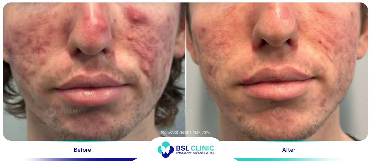 Result-AviClear-Before-After-05