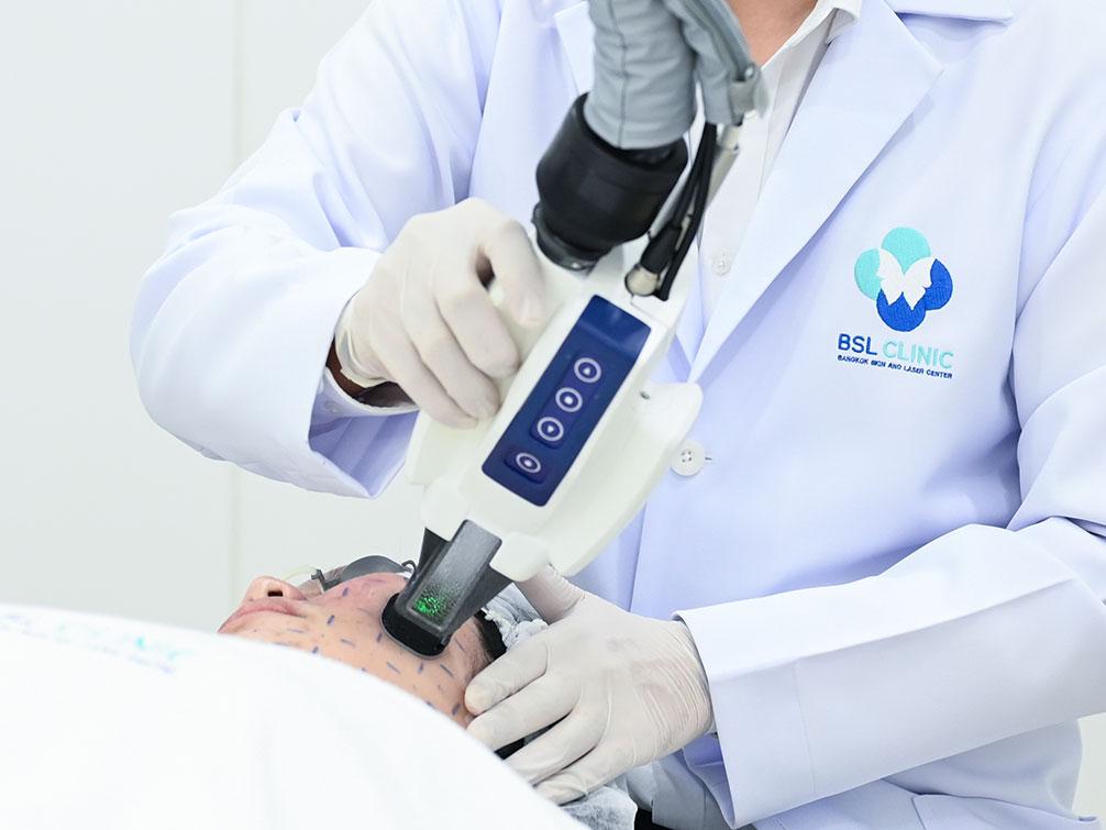 accure laser at bsl clinic