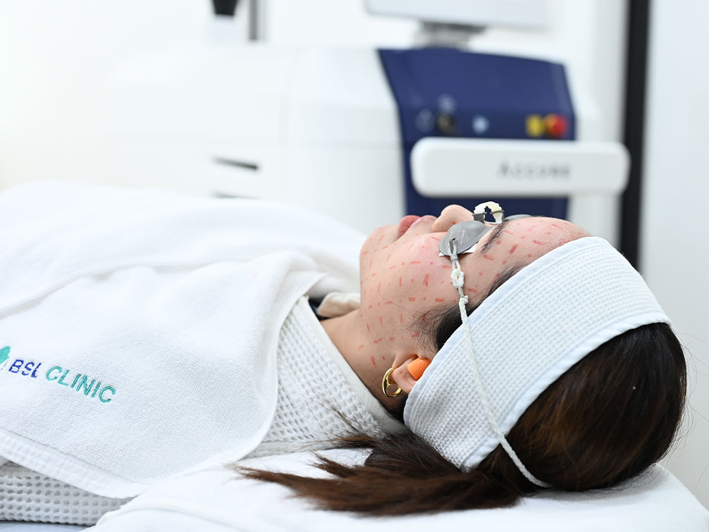 accure laser at bsl clinic