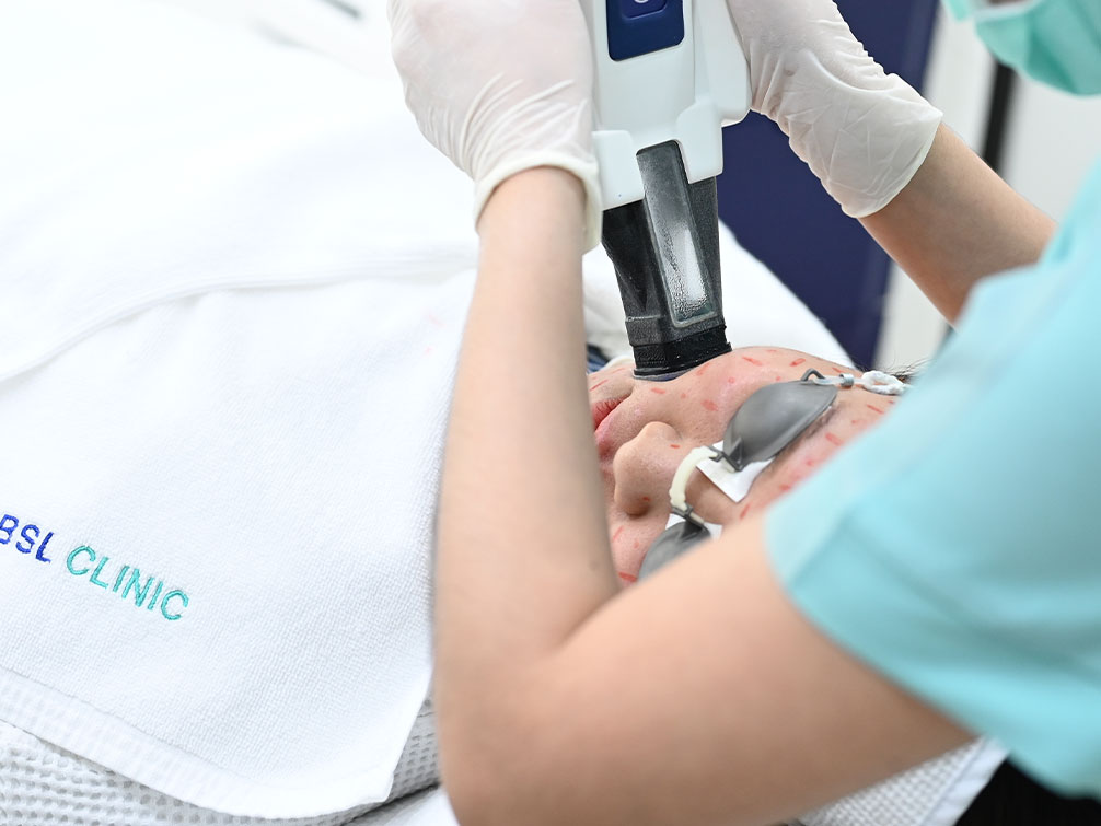 accure laser at bsl clinic