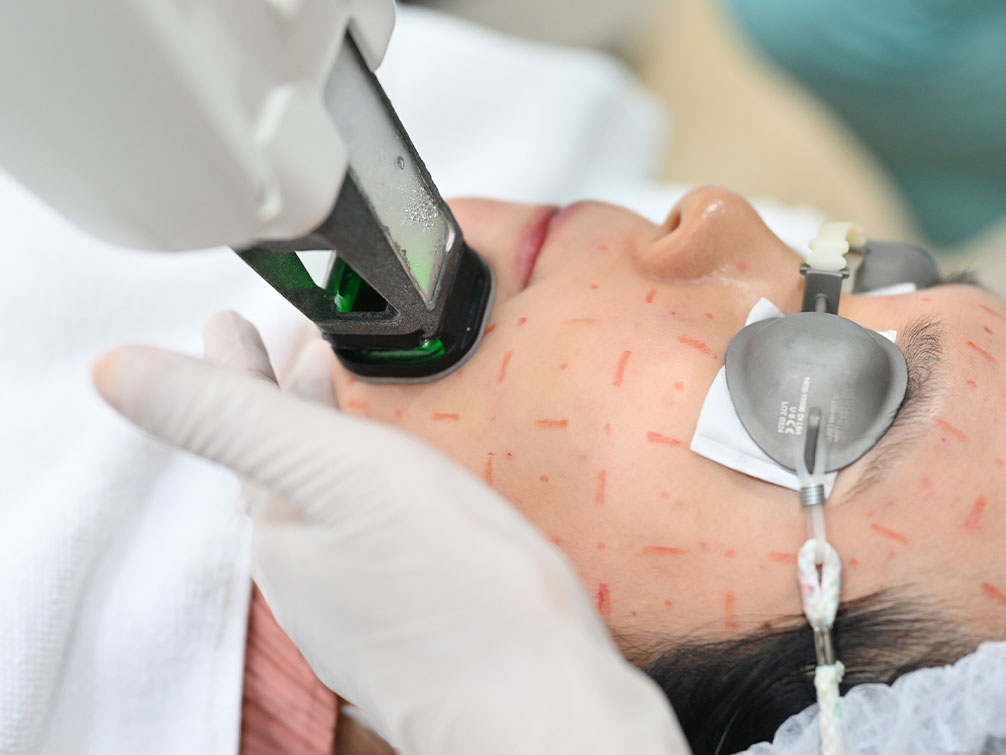 accure laser at bsl clinic