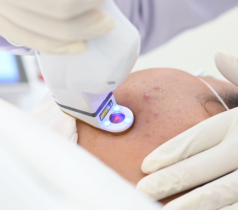AviClear-Laser-at-BSL-Clinic-เลเซอร์รักษาสิว