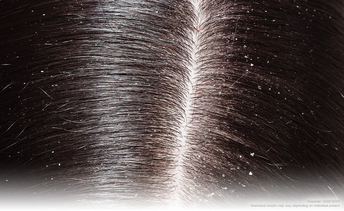 Dandruff