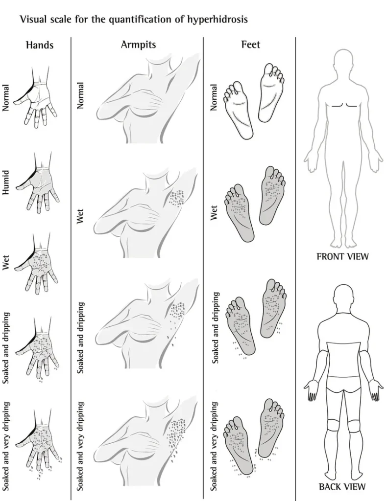 sual-scale-for-the-quantification-of-hyperhidrosis