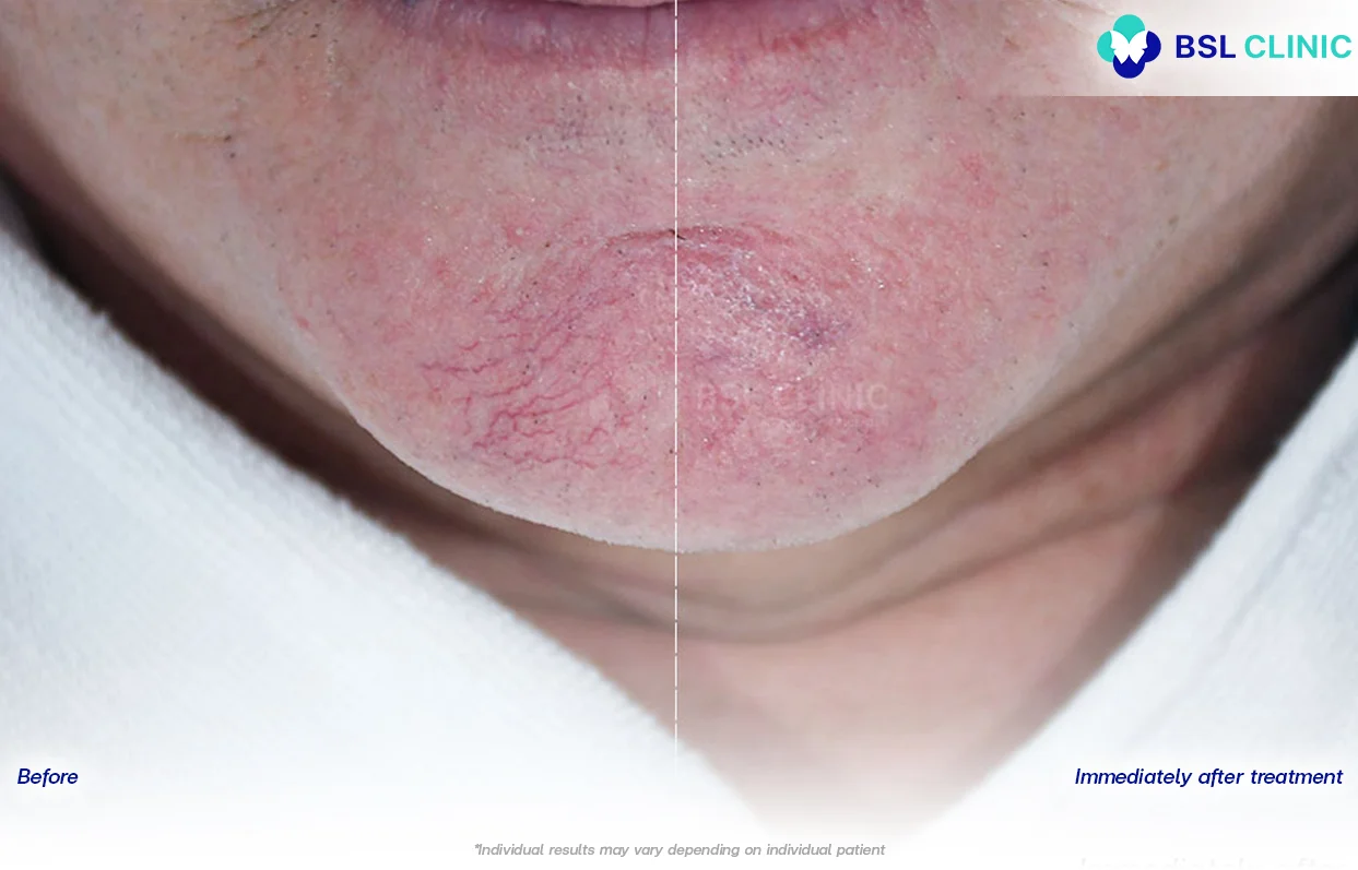 result-Facial-Redness-(Rosacea)-Red-Birthmarks-Spider-and-Leg-Veins