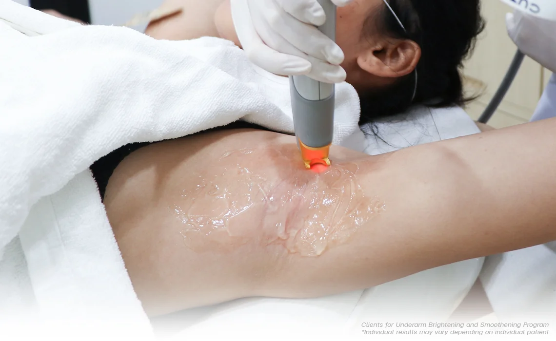 REMOVE-UNDERARM-HAIR-WITH-LASER
