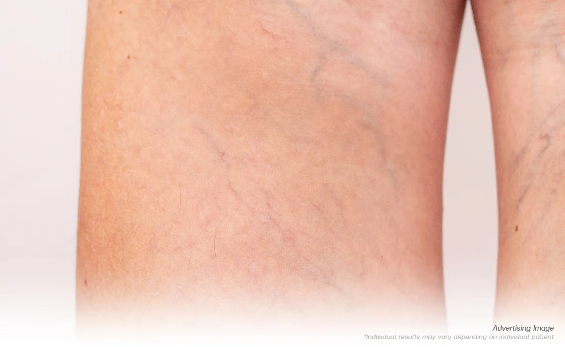 Spider-and-Varicose-Veins-
