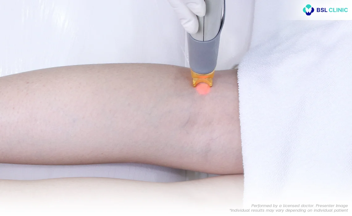 Spider-and-Varicose-Veins-Vascular-Laser