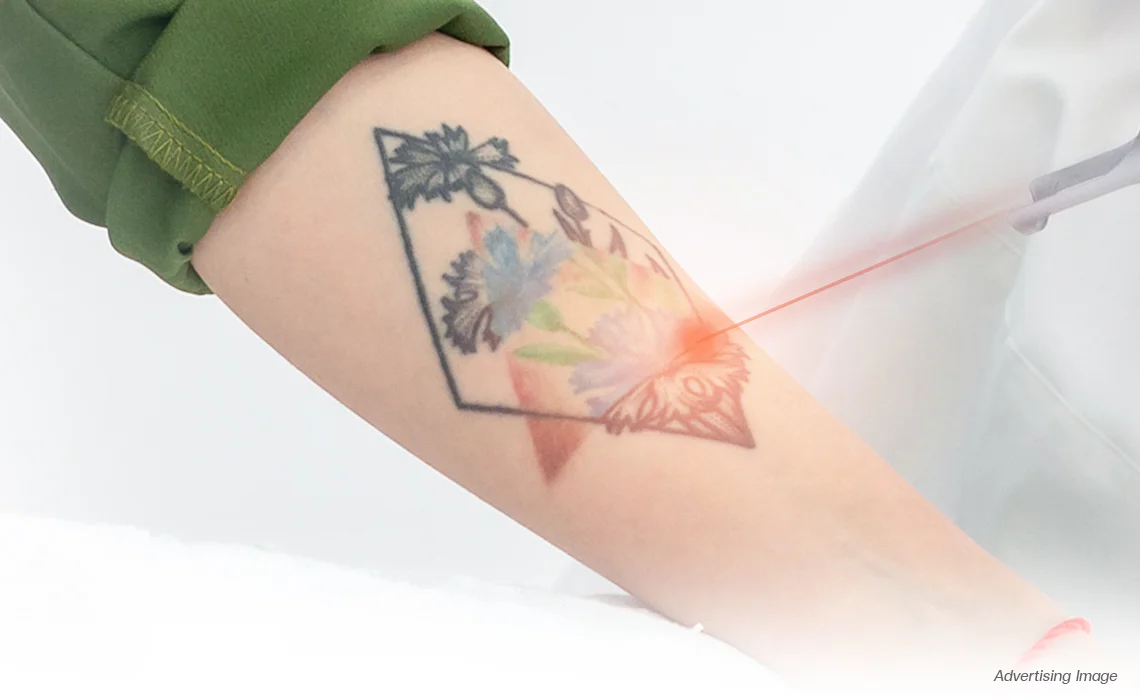 Tattoo-Removal