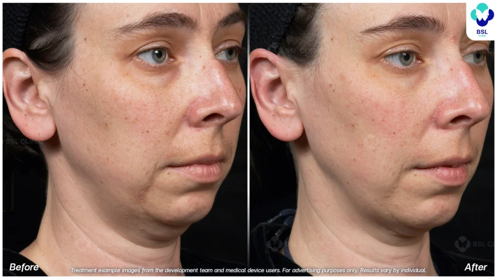 热玛吉前后对比