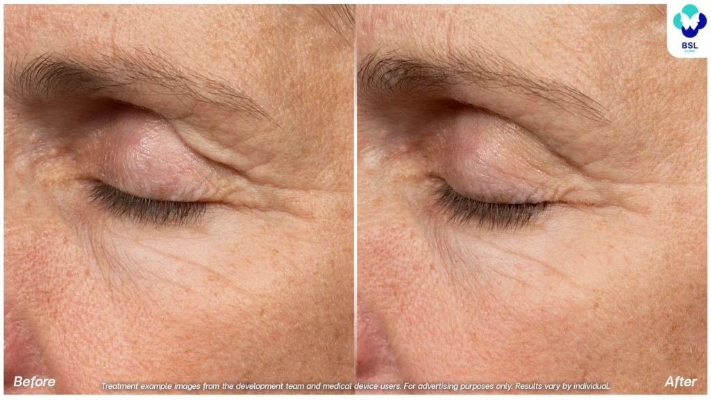 热玛吉年轻化前后对比