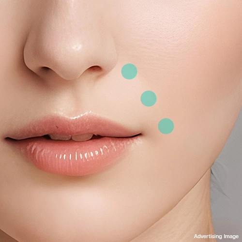 nasolabial-fold-correction-using-filler-for-younger-smooth-facial-design