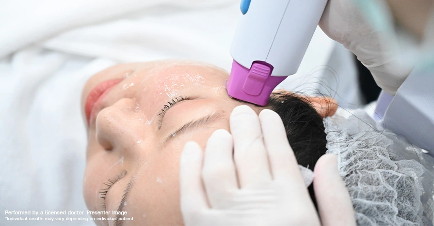 thermage-flx-radiofrequency-tightening-for-younger-facial-design-and-eyelid-lift