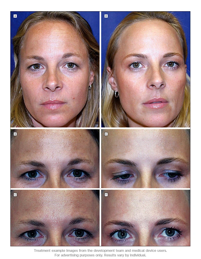 Twin Gets Anti-Wrinkle Injections