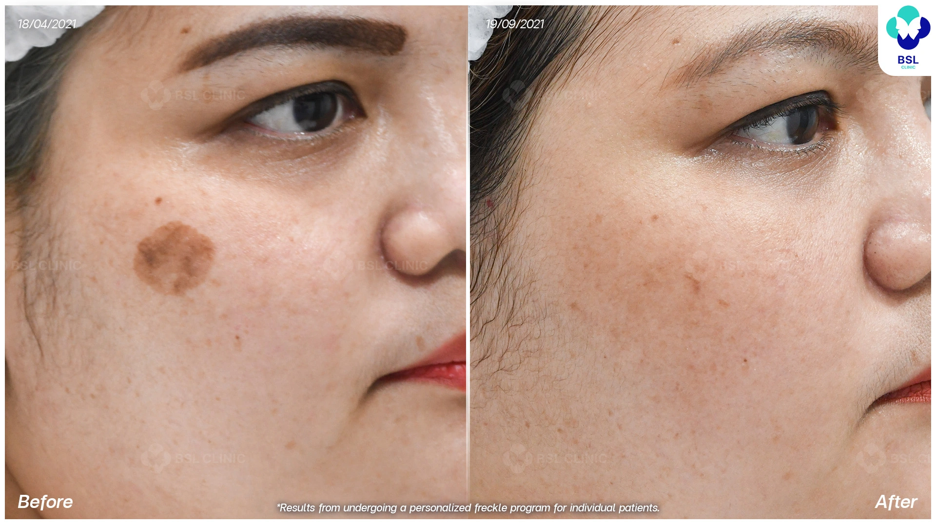 3 Effective Lasers for Freckles, Dark Spots, and Sunspots