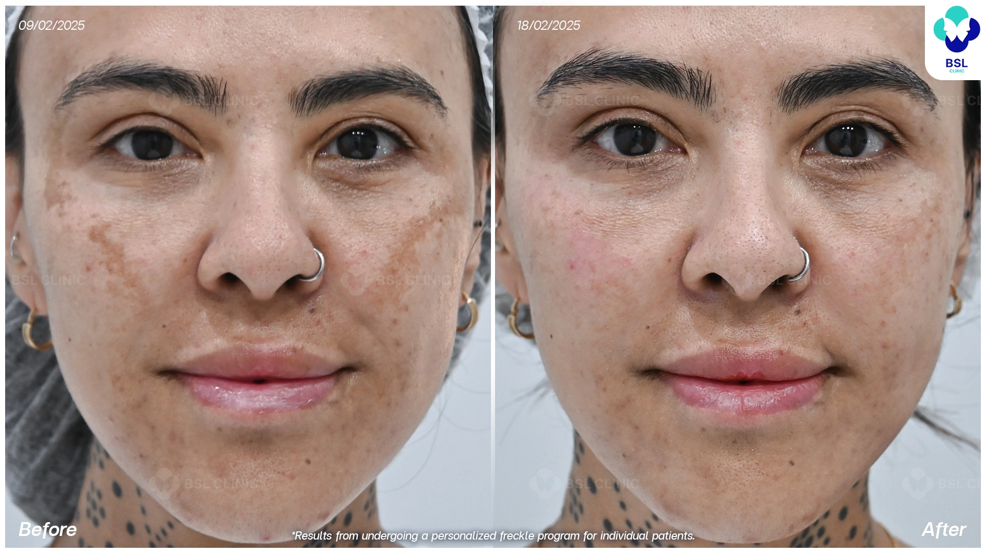 oral pt141 Venous lake of the lip treated with Nd YAG, LONGPULSE Laser: Two case  reports main image 0