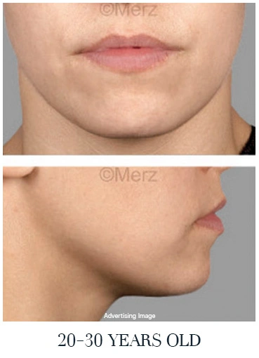 early-signs-of-aging-face-lift-comparison-young-skin-jawline-tightness-before-treatment