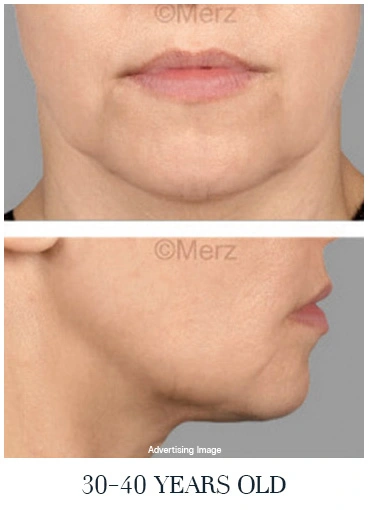face-lift-age-30s-skin-beginning-to-loosen-jawline-softening-before-and-after-skin-firmness