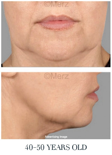 moderate-skin-sagging-40s-face-lift-options-for-midlife-jawline-laxity-facial-aging-signs
