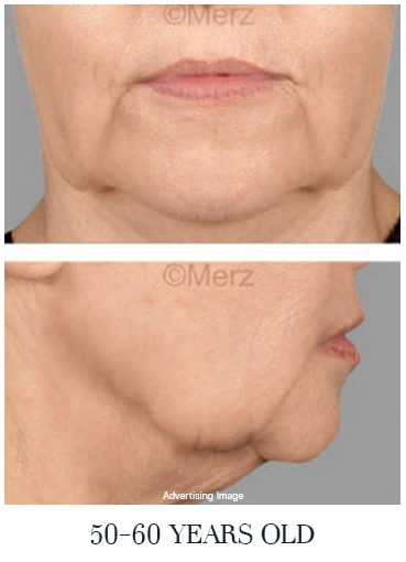 advanced-facial-laxity-50s-face-lift-treatment-reference-loose-skin-neck-jaw-aging-process