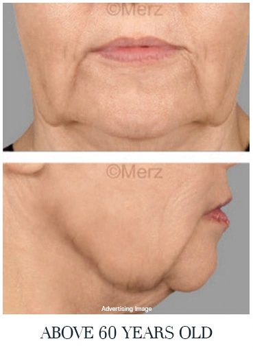 severe-skin-sagging-senior-age-face-lift-before-photo-neck-jowl-laxity-skin-firmness-decline