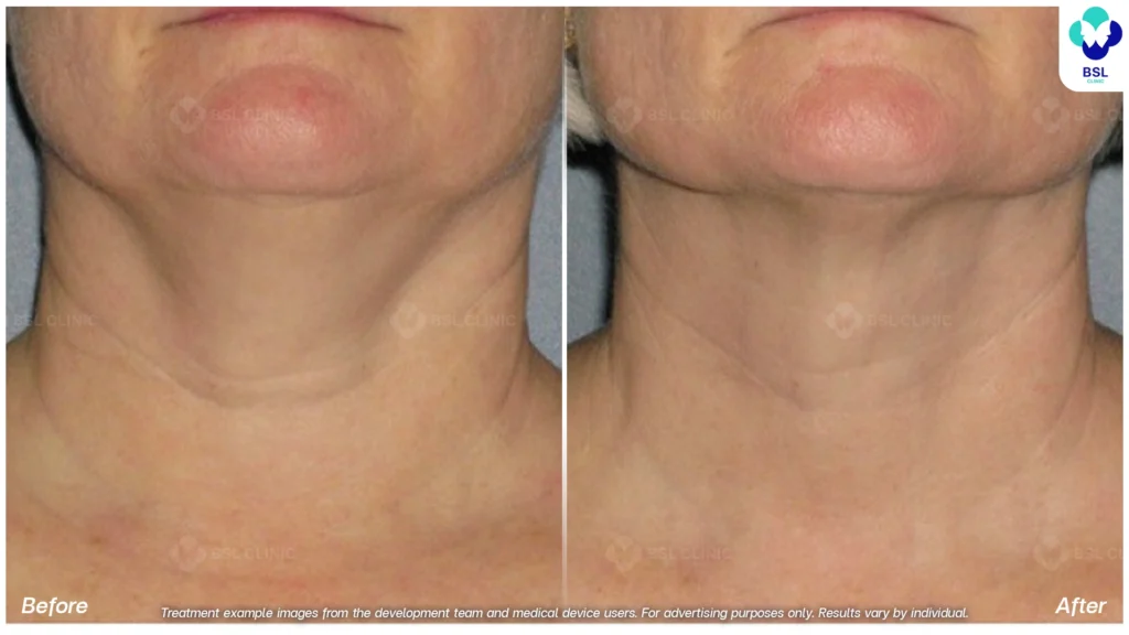 面部提升前后对比2