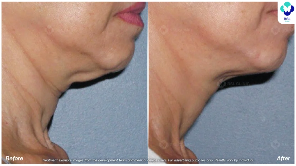 面部提升前后对比