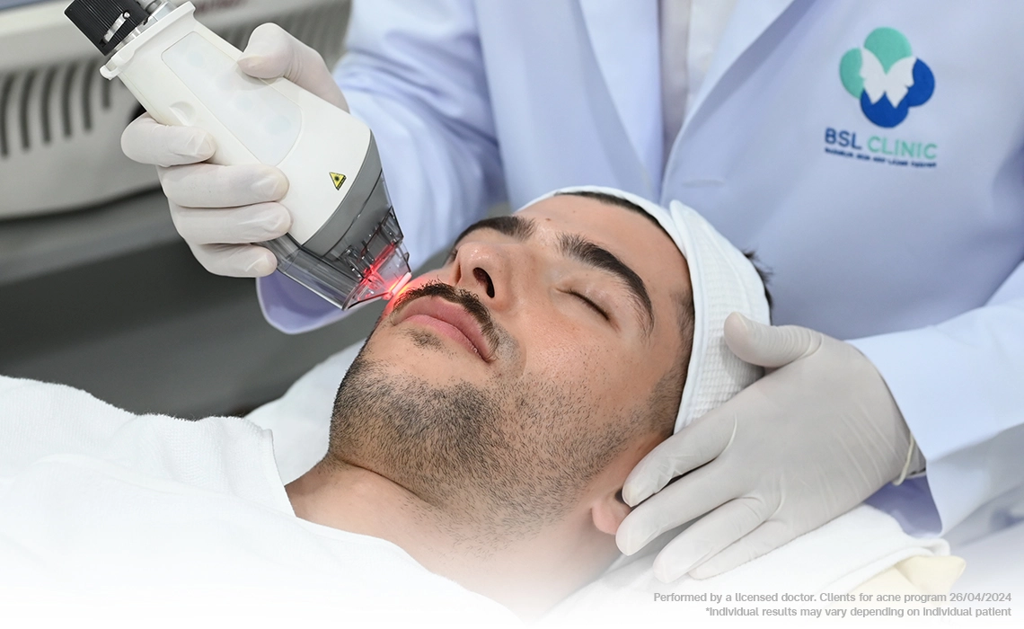 laser resurfacing