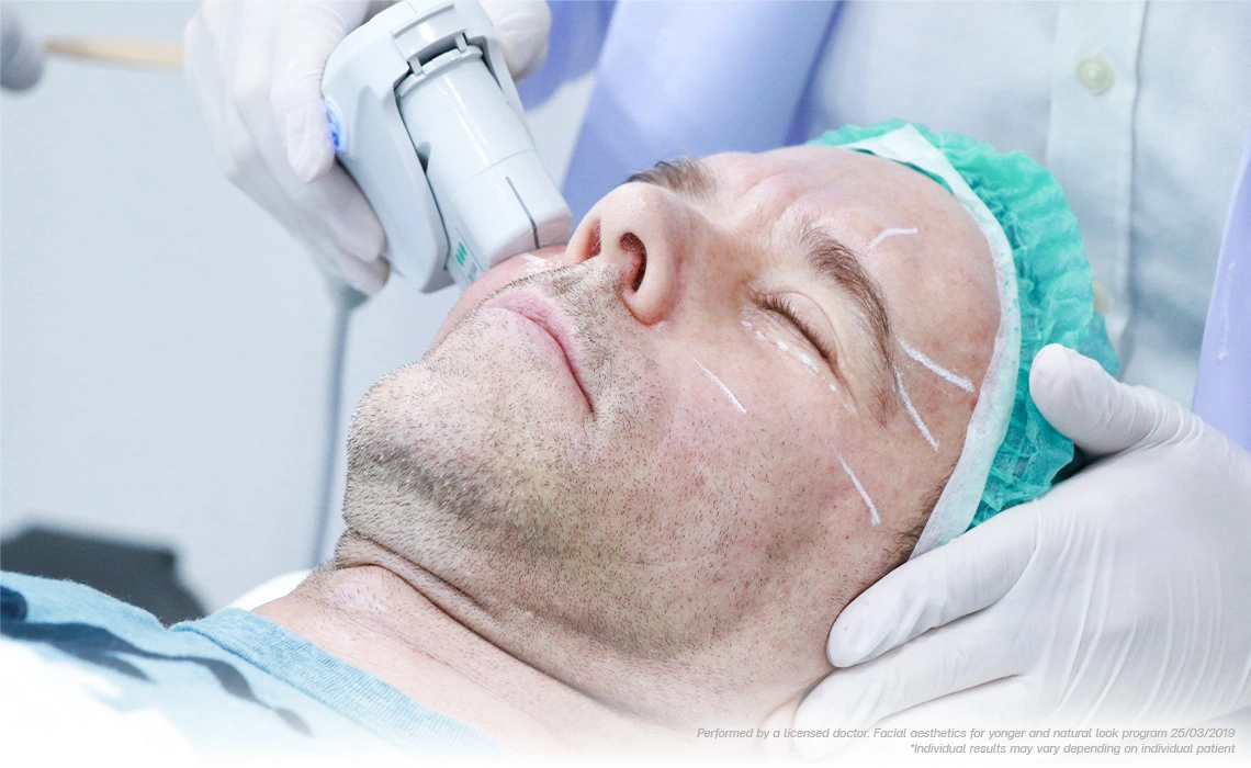 ultherapy-face-lift-for-sagging-jawline-and-neck-rejuvenation-after-60