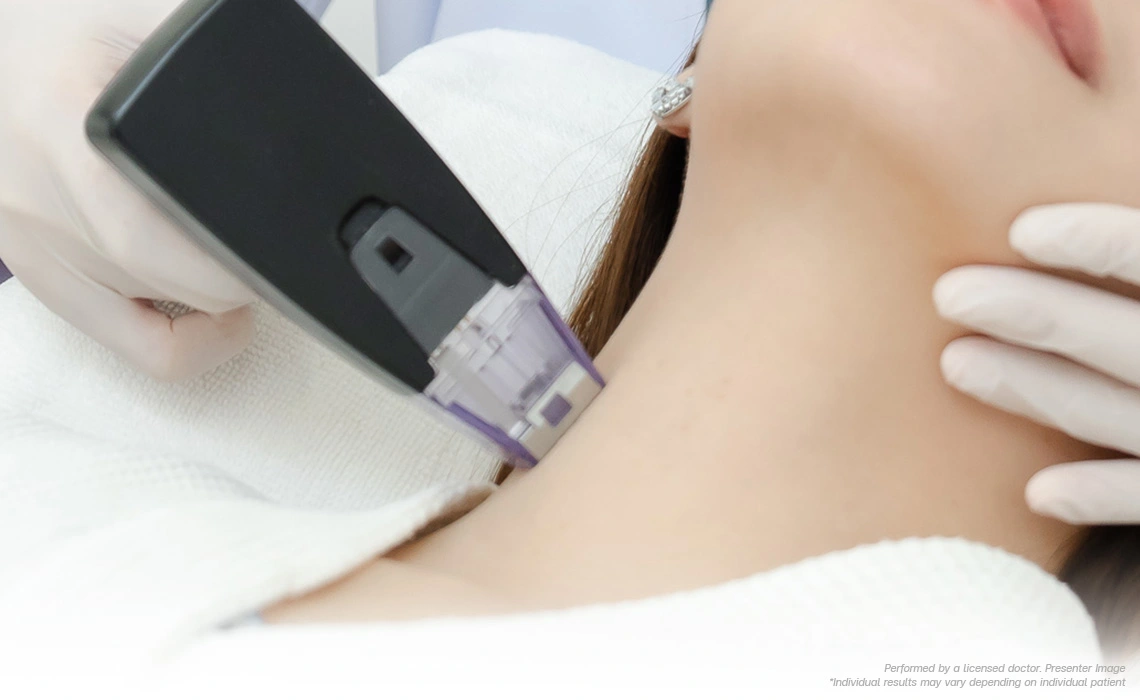 morpheus8-face-lift-skin-refinement-and-pore-tightening-for-60s