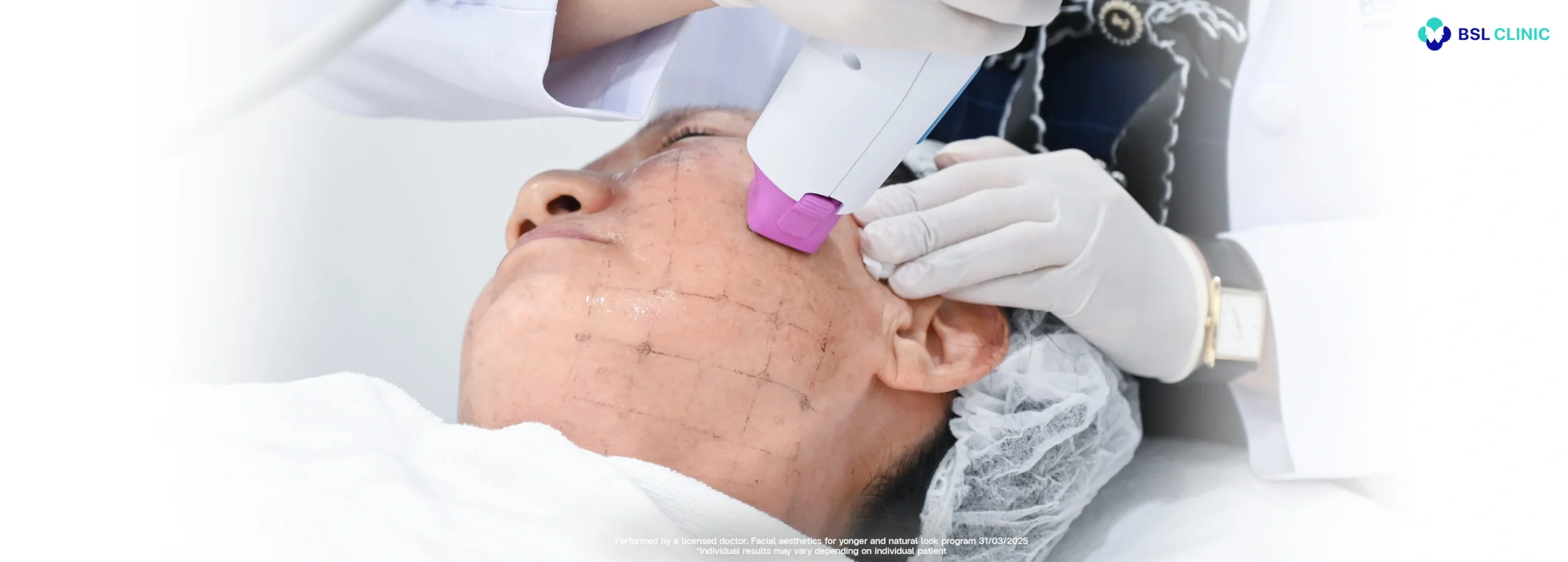 When to Start Treating Thermage