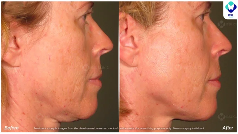 result ulthera
