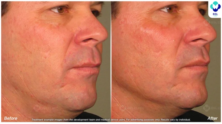 result ulthera