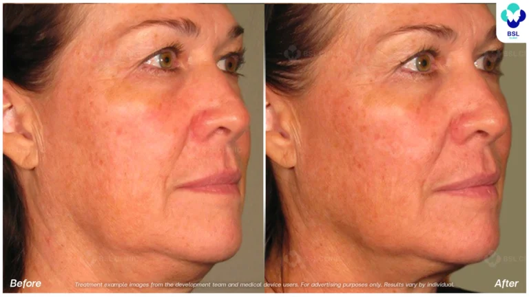 result ulthera