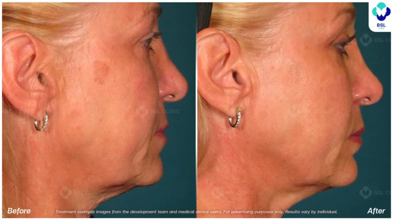 result ulthera