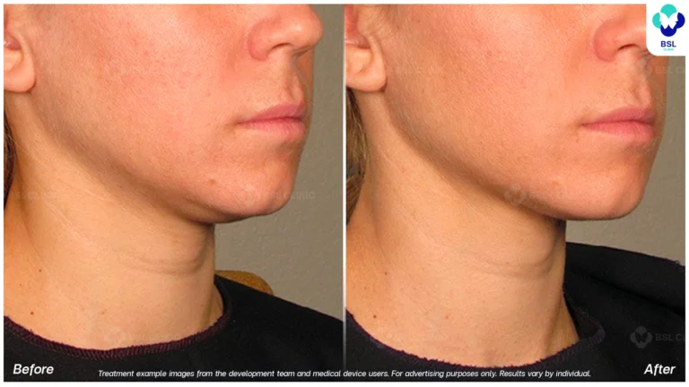 result ulthera