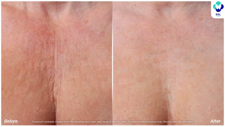 Before After result ulthera Chest