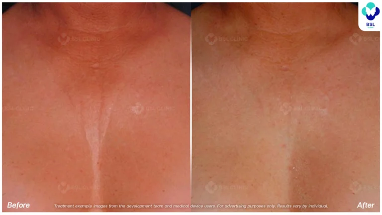 Before After result ulthera Chest