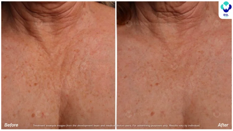 Before After result ulthera Chest