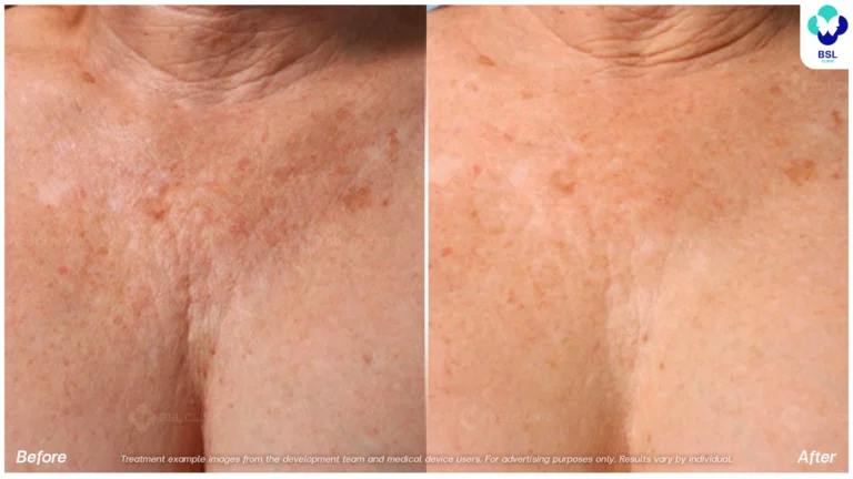 Before After result ulthera Chest